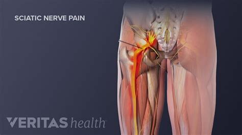 How Massage Can Ease Sciatic Pain - PSJC