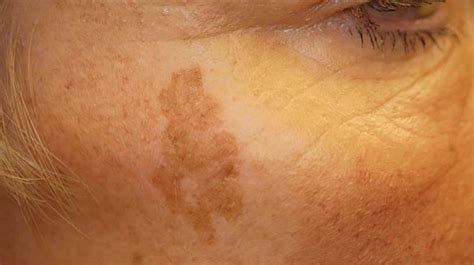 Sunspots on Skin: Causes and Treatment | Skin discoloration, Sunspots on face, Laser skin