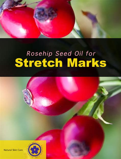 Rosehip Oil for Stretch Marks - Natural Skin Remedies