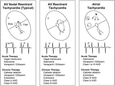 Contemporary Management of Paroxysmal Supraventricular Tachycardia ...