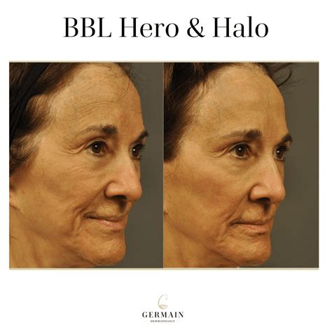 Halo/BBL Laser Before & After | Mt Pleasant, Pawleys Island