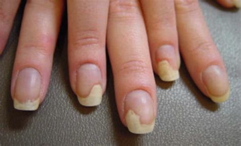 Nail dystrophy definition, causes & treatment