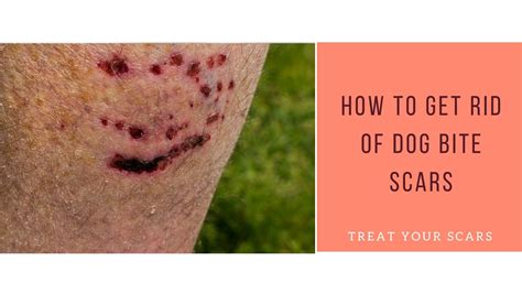 How To Get Rid Of Dog Bite Scars - Treat Your Scars