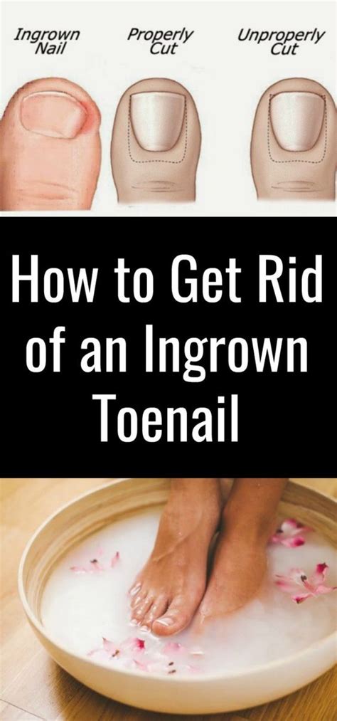 How To Get Rid Of An Ingrown Toenail: Natural Remedies!!!! - HEALTH ...