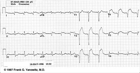 Anterior Wall Myocardial Infarction; Acute Anterior Wall Myocardial ...