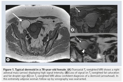 MRI in ovarian cancer