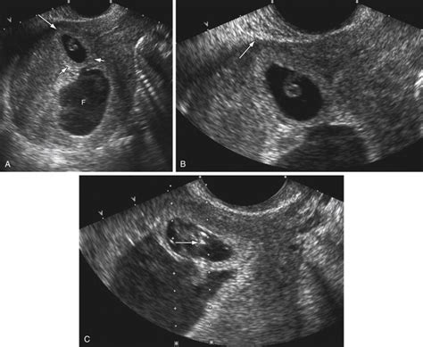 Ultrasound-Guided Treatment of Ectopic Pregnancy | Radiology Key