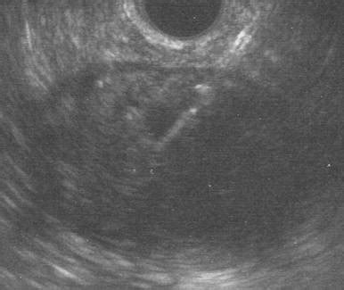 EUS-FNA Diagnosis of a Pancreatic Lymphoepithelial Cyst: Three-Year ...