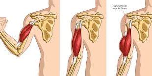 porción larga del bíceps – Blog de Fisioterapia