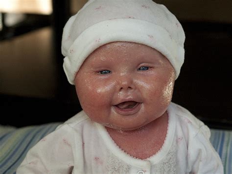 Meet Brenna, a baby with Harlequin Ichthyosis - Photo 3 - Pictures - CBS News