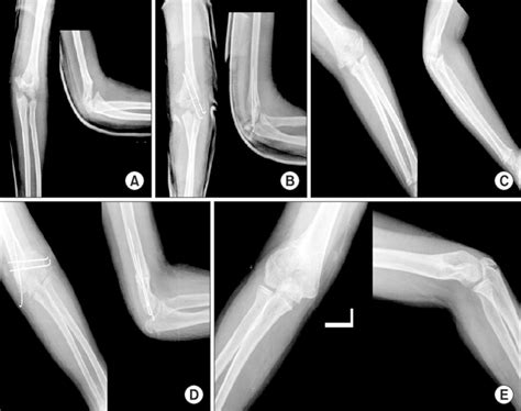 A 9-year-old male patient with cubitus varus deformity. (A)... | Download Scientific Diagram