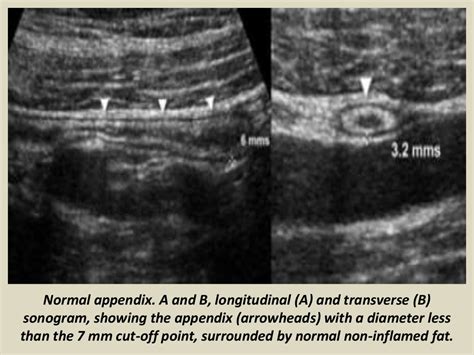 Presentation1.pptx, ultrasound examination of the appendix.