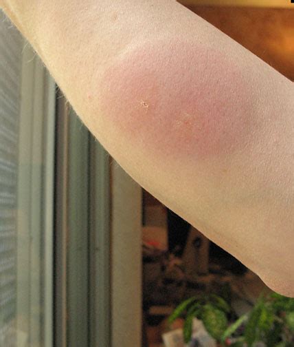 Mosquito Bites - Treatment, Remedies | Why Do Mosquito Bites Itch | Diseases Pictures