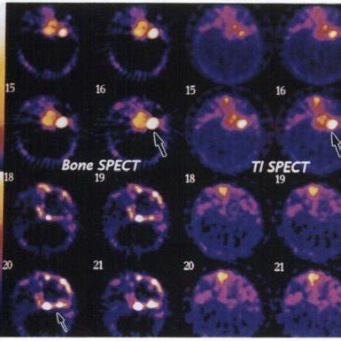 (A) PreoperativeCT scanfrom a 37-yr-oldmanwith chondrosarcoma of the ...