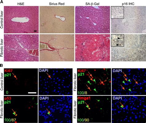 Senescence of Activated Stellate Cells Limits Liver Fibrosis: Cell