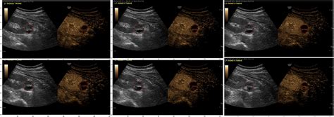 Renal Cyst Ultrasound