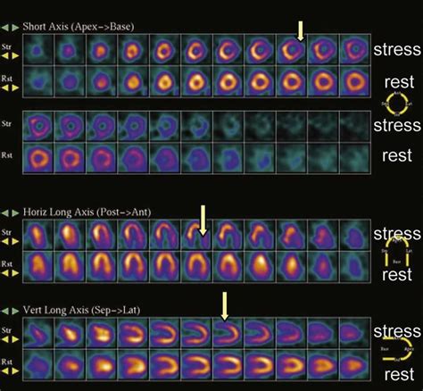 Pin on Interventional Cardiology