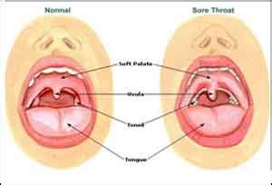 Sore throat, swollen glands linked to thyroid cancer