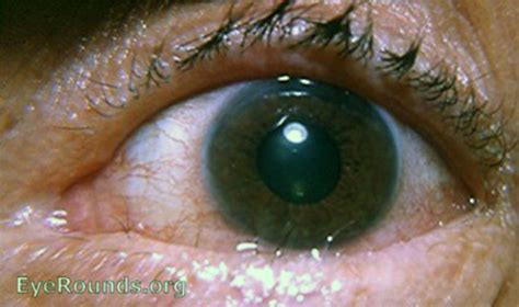 Ocular pemphigoid. EyeRounds.org: Online Ophthalmic Atlas