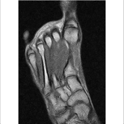 The hallux is shown in a proper alignment. In the distal part of the... | Download Scientific ...