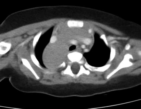 CT scan of chest illustrates a mass in the right posterior mediastinum,... | Download Scientific ...