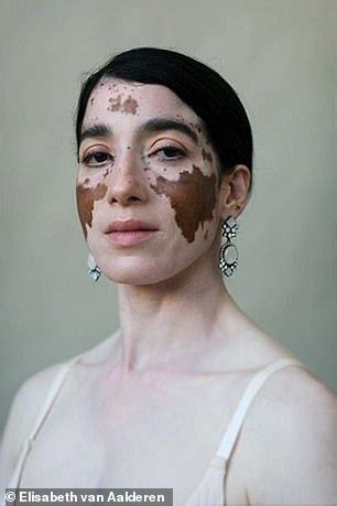 Photographer with vitiligo showcases the 'unique beauty' of the ...