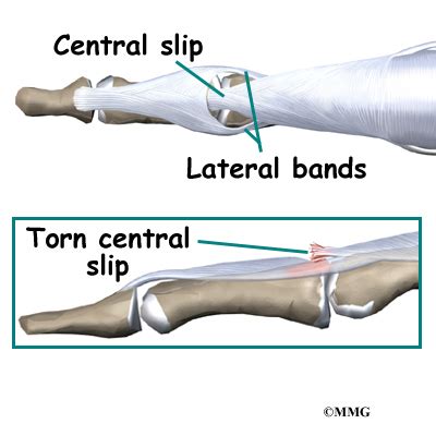 Boutonniere Deformity of the Finger | eOrthopod.com