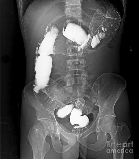 Reverse Intestinal Malrotation And Colon Malrotation by Rajaaisya/science Photo Library