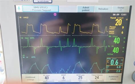 canto ordinare Salva ventilator settings simv piegare farti arrabbiare pelle