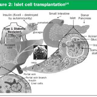 Islet cell transplantation 14 | Download Scientific Diagram