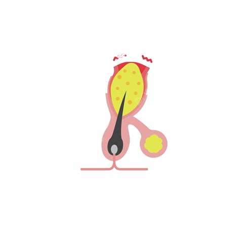 Papule Progression A Closer Look At Pore Crosssection Vector, Papule ...