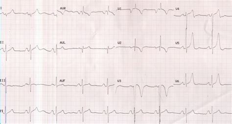 P mitrale and right ventricular hypertrophy – All About Cardiovascular System and Disorders