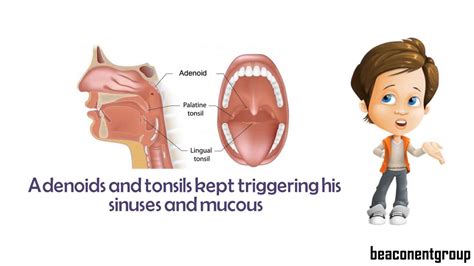 Adenoids In Children