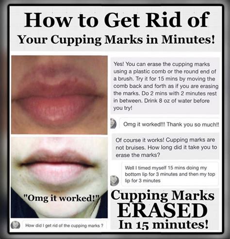 How to Get Rid Of Cupping Marks Quickly - CandyLipz