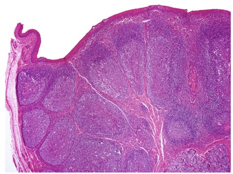 Pharyngeal Tonsils Histology Labeled