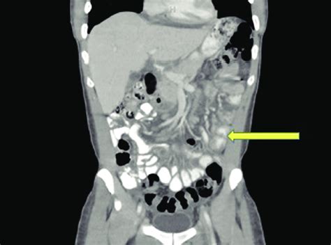 Computed tomography scan of abdomen and pelvis with contrast showing ...