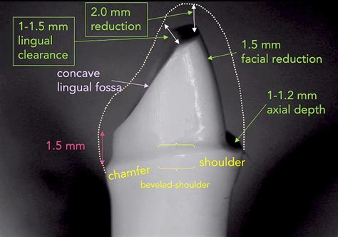 TOOTH PREPARATION: Anterior PFM preparation - Dr. Richard Stevenson