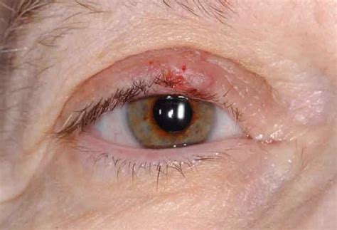 Sebaceous carcinoma causes, symptoms, diagnosis, treatment & prognosis