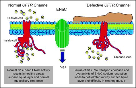 Cystic Fibrosis Lung Disease: An Overview | Respiratory Care