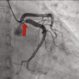 (a and b) Coronary CT angiography demonstrating proximal left... | Download Scientific Diagram