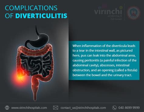 Complications of Diverticulitis | Diverticulitis, Inflammation, Cavities