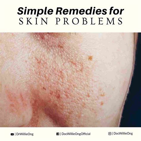 Simple Remedies For Skin Problems - Doc Willie Ong