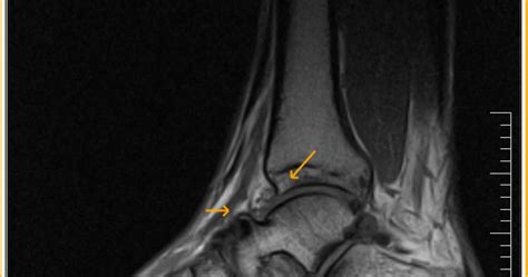 Anterior ankle impingement-MRI - Sumer's Radiology Blog