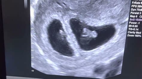 7 Week Ultrasound Identical Twins