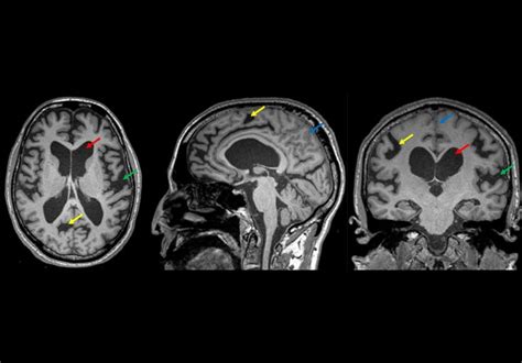 Hydrocephalus Symptoms And Causes Mayo Clinic - vrogue.co