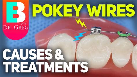 Pokey Wire / Braces Pain: Causes and Fixes - YouTube