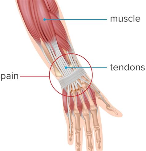 Wrist Tendinitis Surgery / De quervain's Release | Andrew J. Leo, MD ...