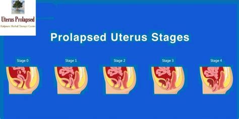 What is Pelvic Organ Prolapse? Article - ArticleTed - News and Articles