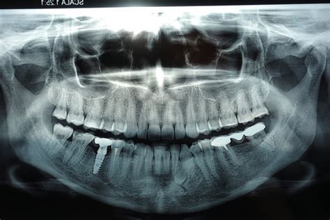 Digital X-Rays - Desert Dental Spa