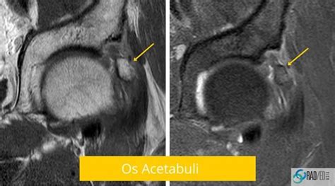 Hip MRI ? Show me the Xray: Acetabular Rim Ossifications. How to make ...